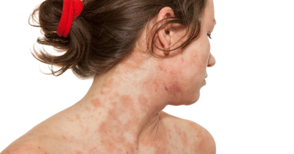 Penicillin Allergy - Symptoms, Causes, Treatments